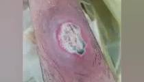 آموزش درمان سوختگی پا  توسط متخصص زخم