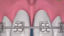 بستن فضای بین دندانی به کمک یک جراحی کوچک