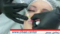 تزریق ژل به لب - برجسته کردن لب با تزریق چربی - زیبایی سنتر