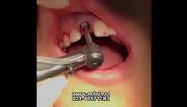 فیلم کاشت ایمپلنت دندان جلو در دندانپزشکی