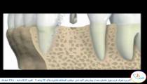 ویدیو انیمیشن کاشت ایمپلنت دندان