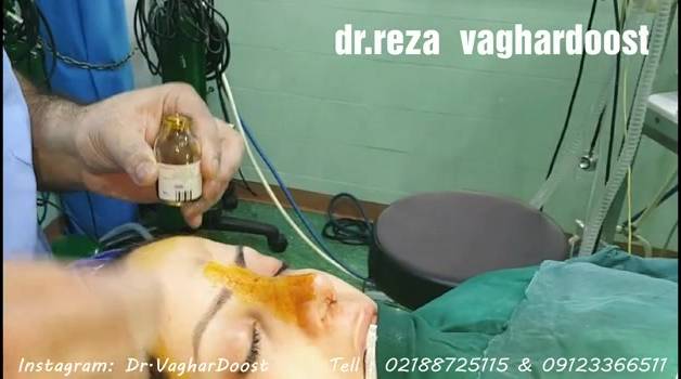 جراحی زیبایی بینی (پارت هشت)