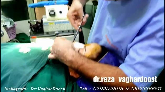 جراحی زیبایی بینی (پارت نه)