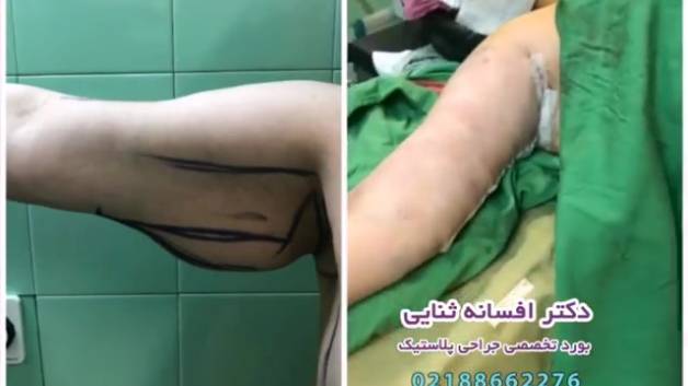 جراحی لیفت بازو