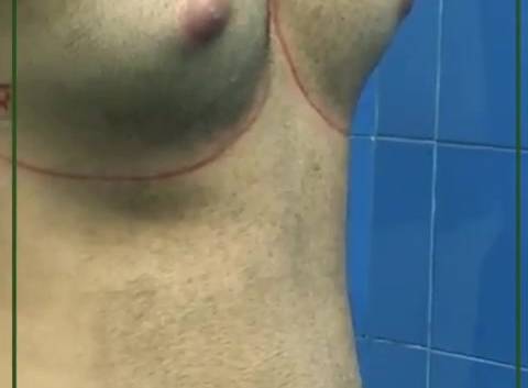 فیلم جراحی ژنیکوماستی