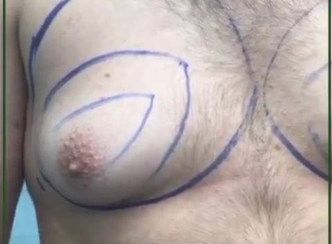 فیلم عمل زيبايى ژنيكو ماستى