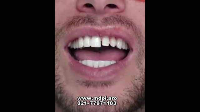 لمینت کردن دندان فک بالا چگونه است