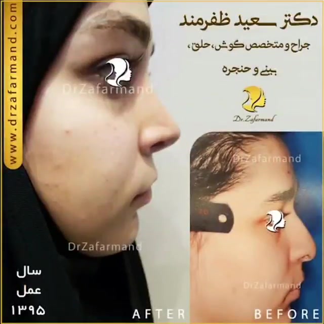 نمونه کار جراحی بینی دکتر سعید ظفرمند